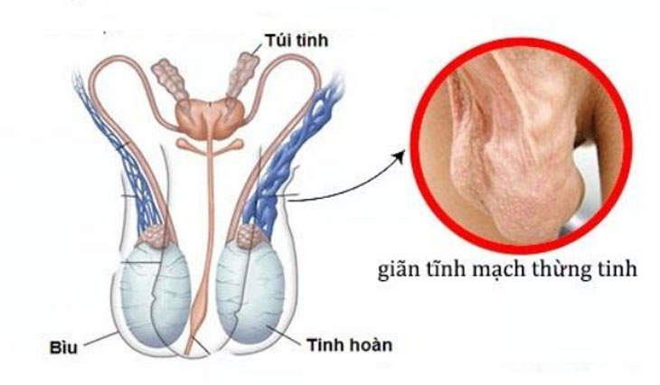 giãn tĩnh mạch tinh