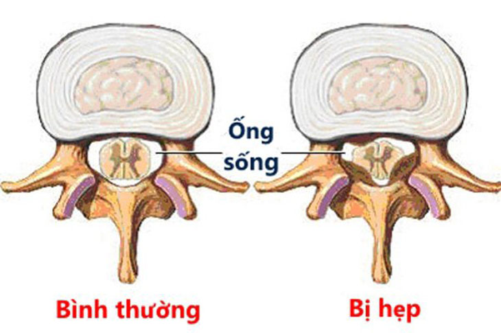 hẹp ống sống