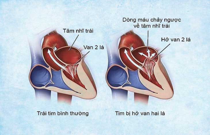 hở van hai lá