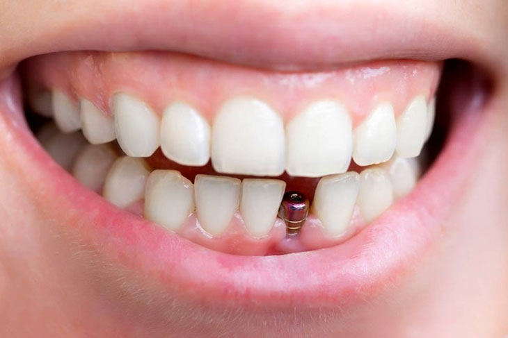 cấy ghép implant
