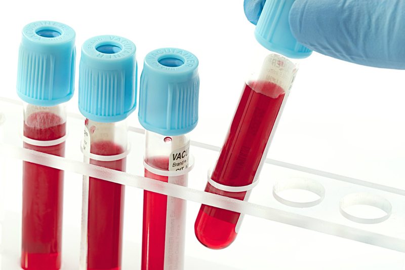 Kiểm tra lipid máu