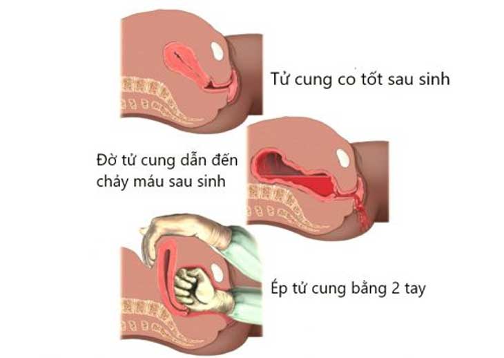 Kiêng cữ sau sinh