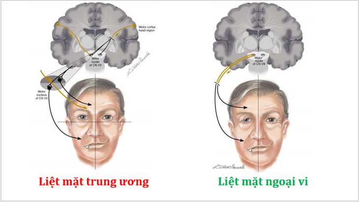 liệt mặt