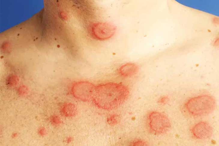 Lupus ban đỏ