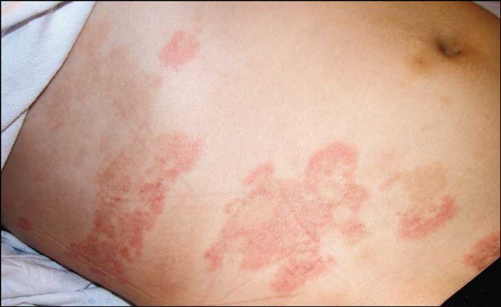 Lupus ban đỏ