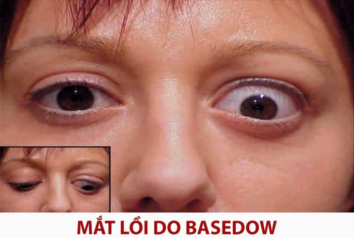 lồi mắt sau bệnh Basedow