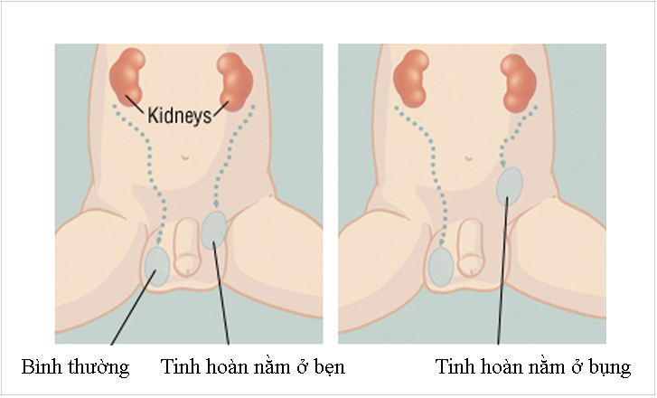 tinh hoàn ẩn