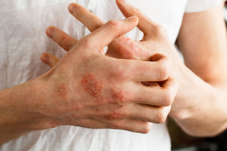 Ngứa khi trời lạnh