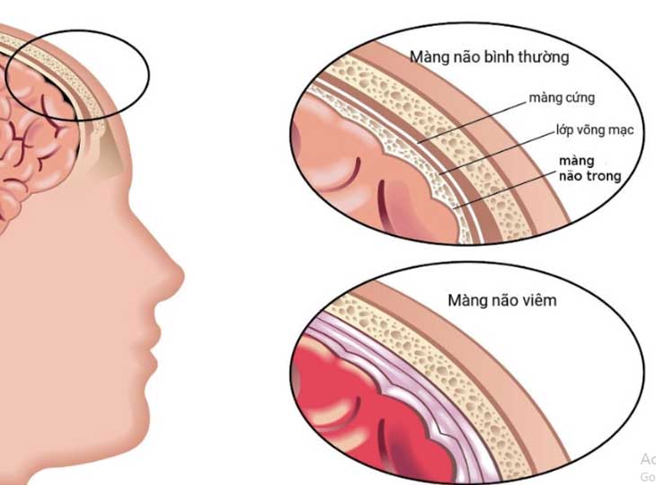 Nhức đầu