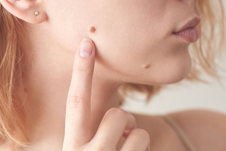 nốt ruồi bị ác tính hóa