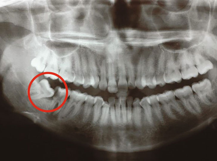 width=răng khôn mọc lệch