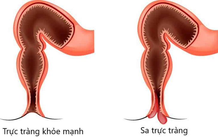 sa trực tràng