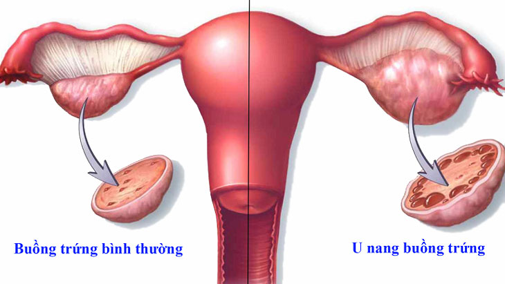 U nang buồn trứng