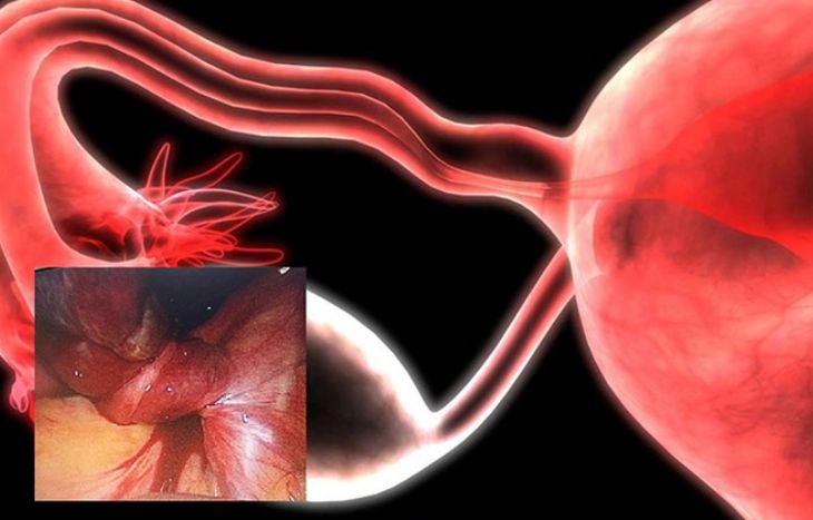 U nang buồng trứng