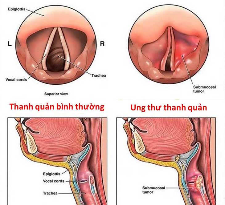 ung thư thanh quản
