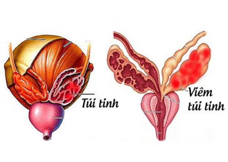 Viêm túi tinh