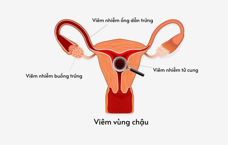 Viêm vùng chậu: nguyên nhân, triệu chứng và cách điều trị