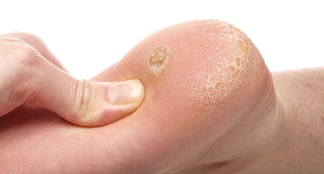 Bệnh mắt cá chân