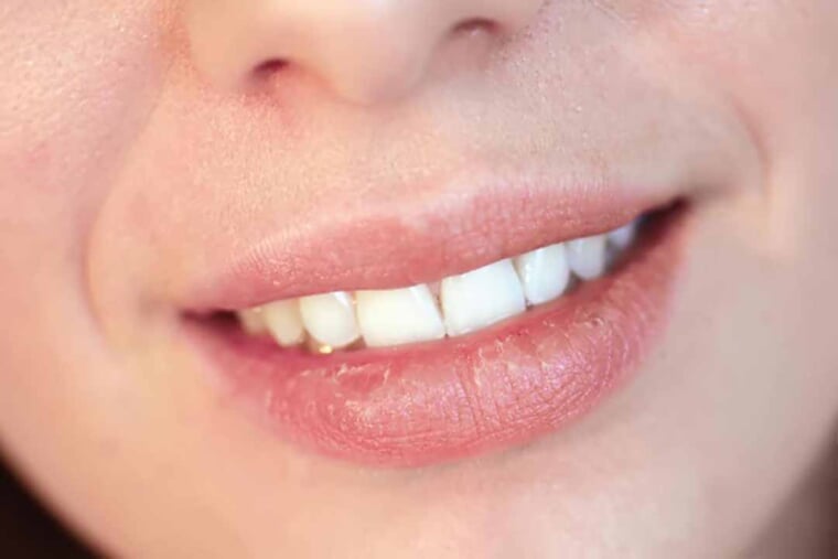 Dấu hiệu của chứng khô miệng