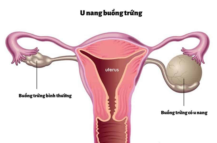 dau-bung-duoi