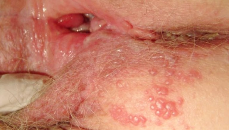 Mụn rộp vùng kín là bệnh lây qua đường tình dục