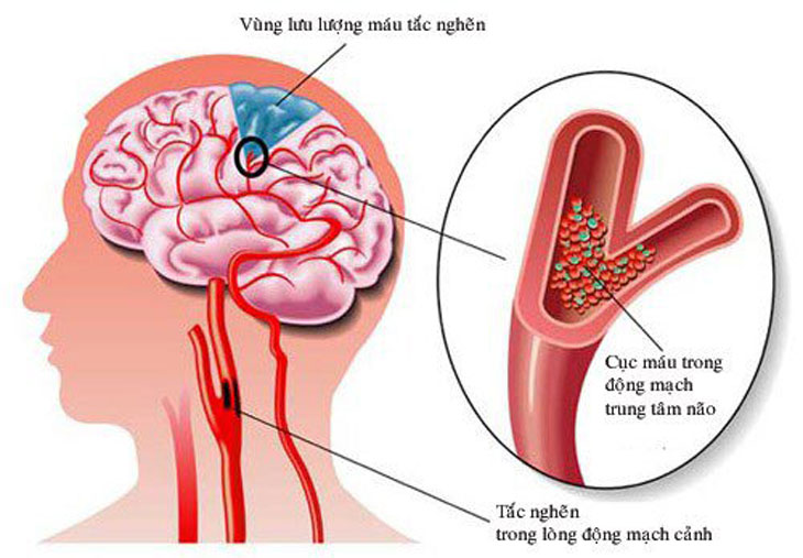 bệnh nhồi máu não cấp