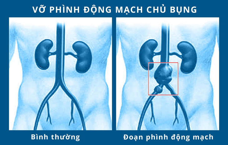 Phình động mạch chủ
