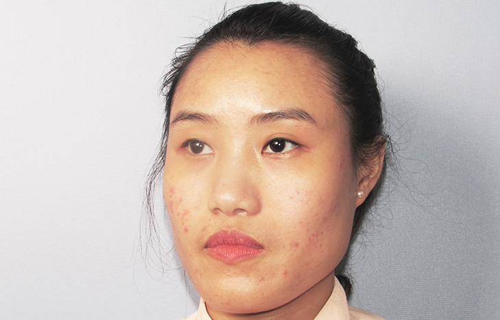 sửa mí mắt hỏng