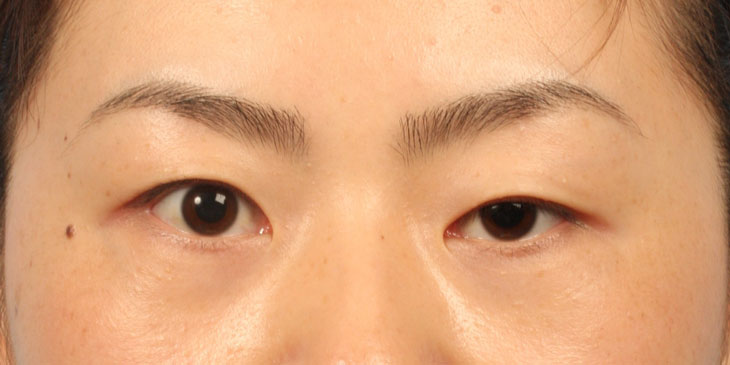 sụp mí mắt