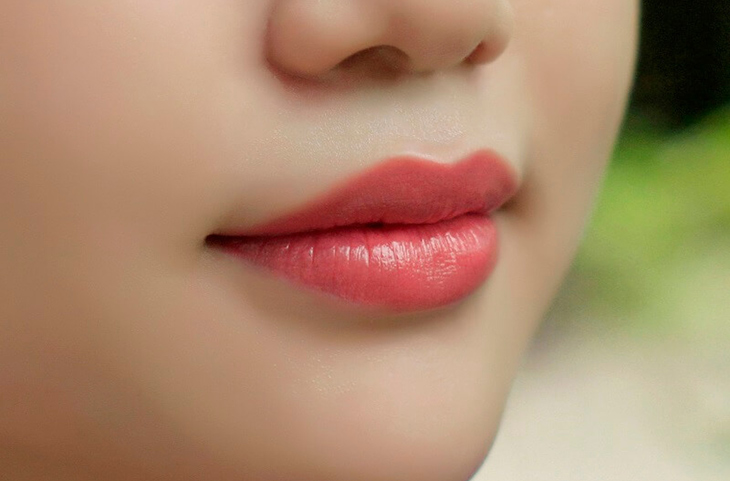 phẫu thuật thu gọn môi