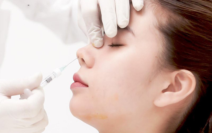tiêm filler nâng cao sống mũi