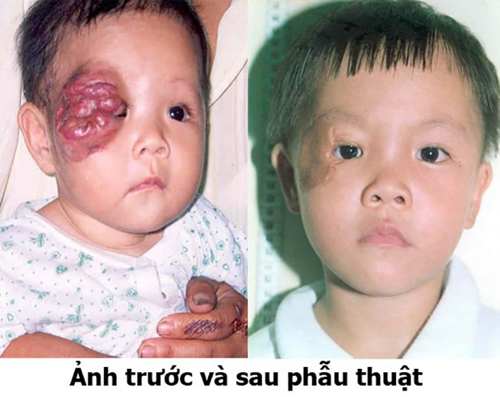 u máu ở trẻ