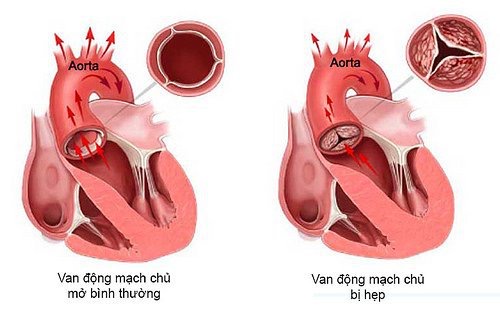 bệnh tim có nên mang thai