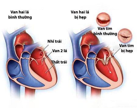 bệnh tim có nên mang thai