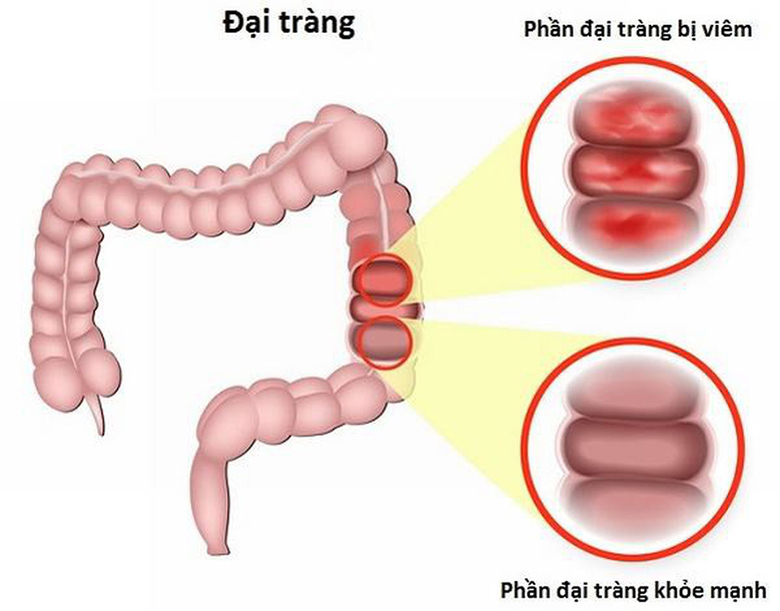 10 bệnh đại tràng thường gặp nhất