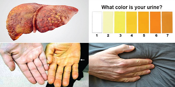 Da vàng là dấu hiệu của các bệnh về gan