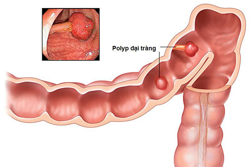 polyp đại tràng