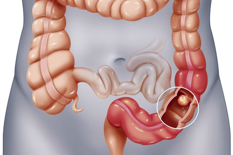 Điều trị polyp đại tràng