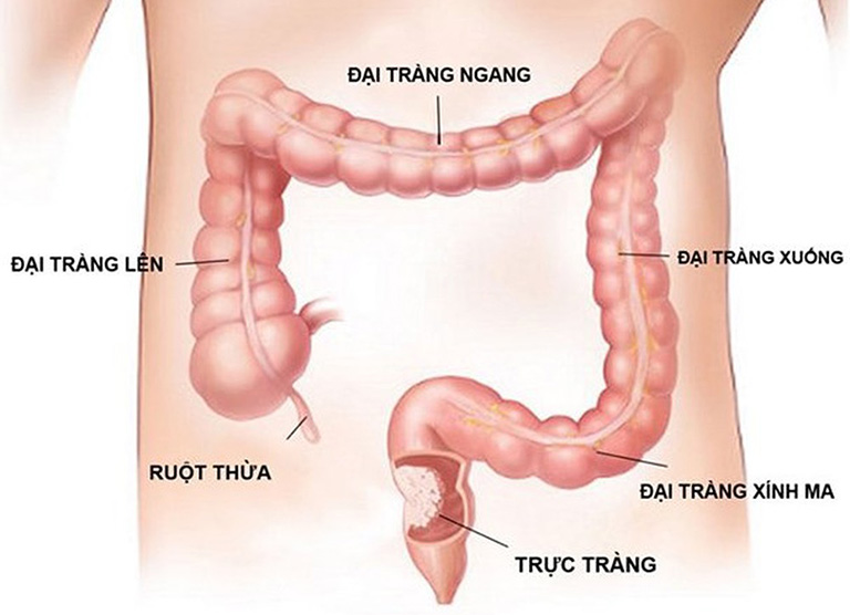 Polyp đại tràng sigma