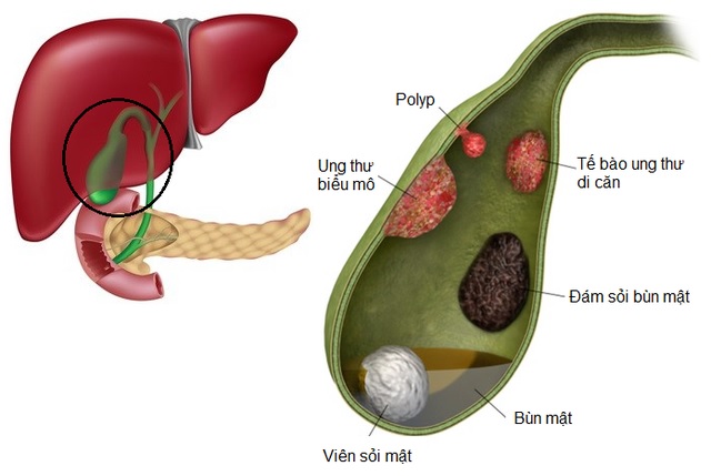 polyp túi mật