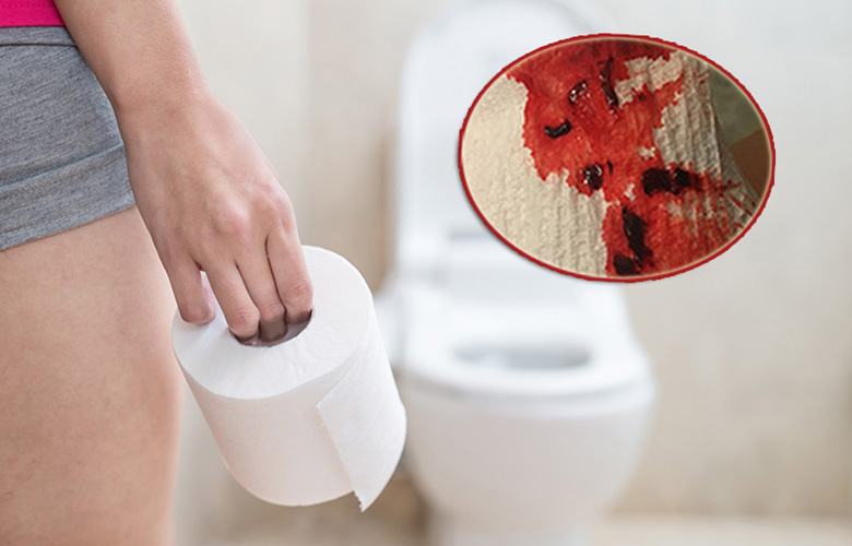 Bệnh sa trực tràng có thể dẫn đến đi ngoài ra máu rất khó kiểm soát