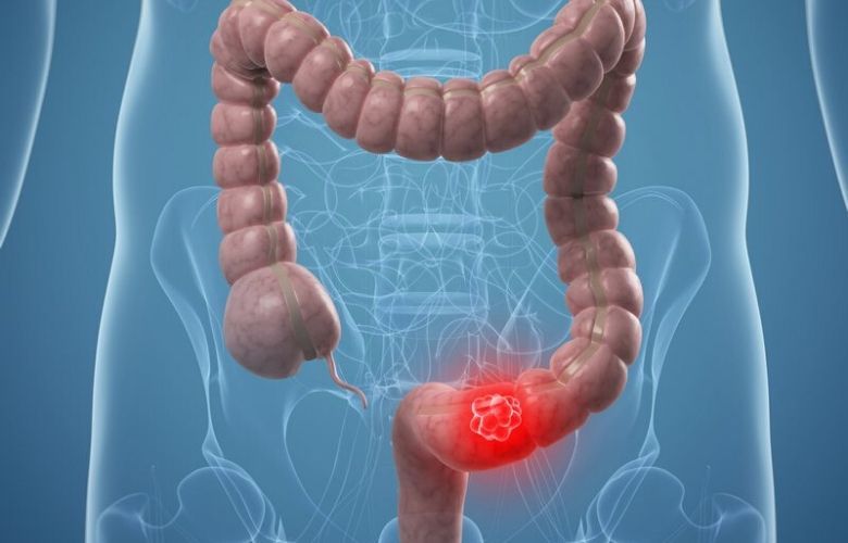 polyp đại tràng