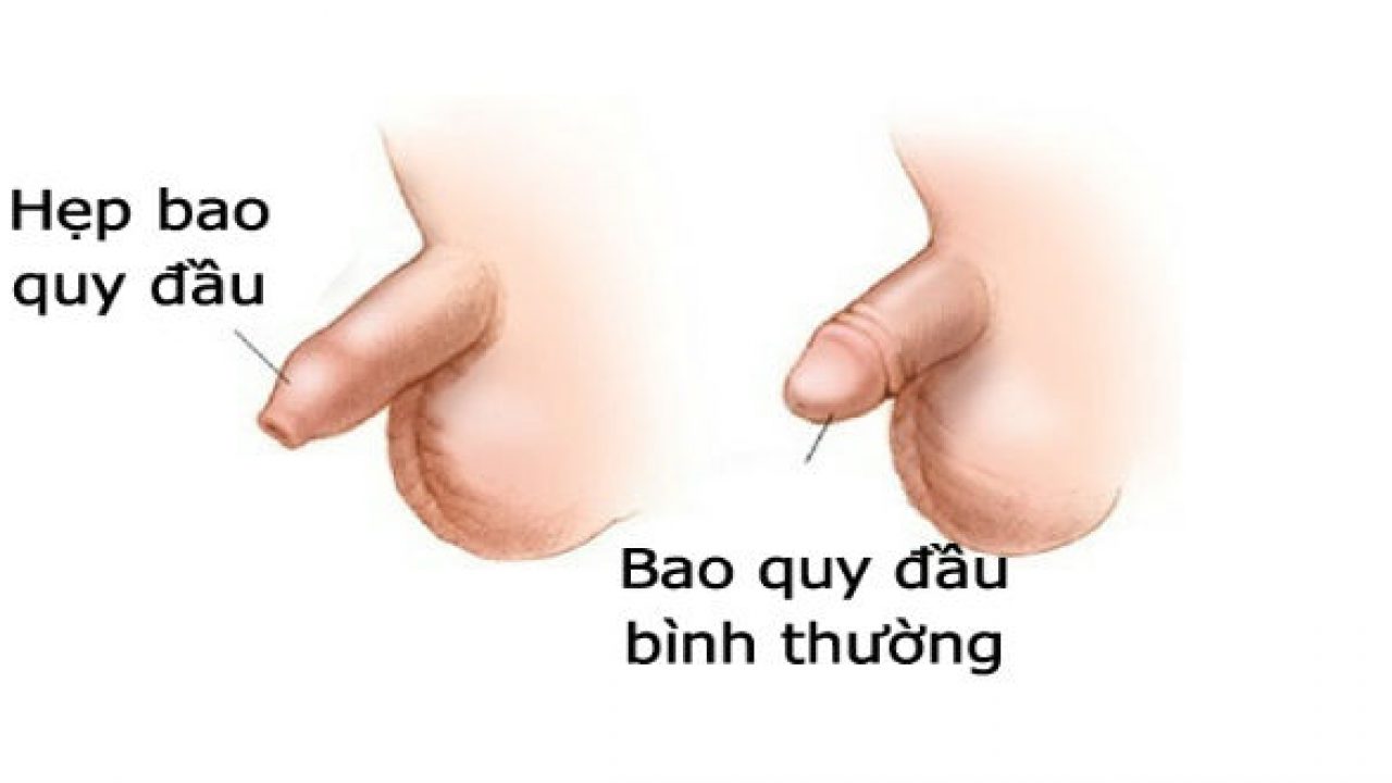 bệnh lý vùng kín ở bé trai
