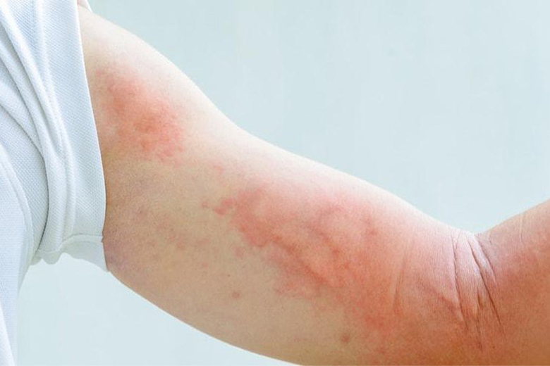 Sẩn ngứa nang lông là bệnh ngoài da ở mẹ bầu thường mắc phải