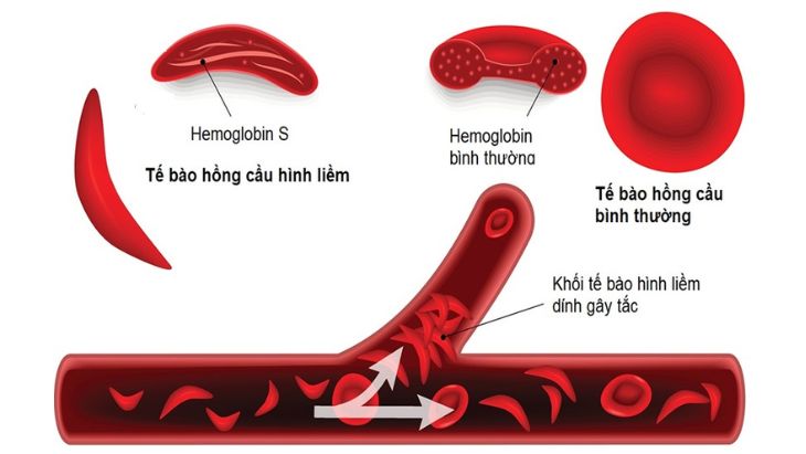 Lấy máu gót chân