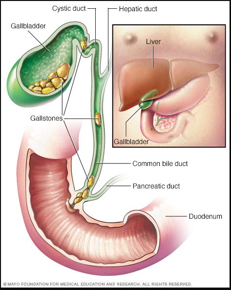 Minh họa sỏi cholesterol túi mật