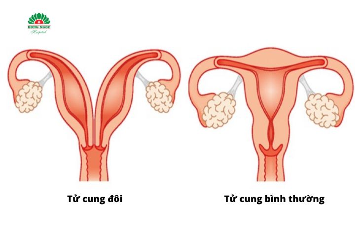 Tử cung đôi là bất thường vô cùng hiếm gặp