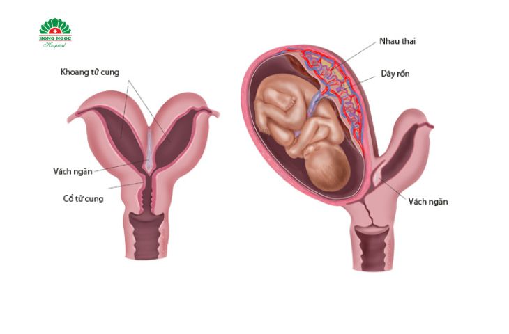 Bất thường ở tử cung