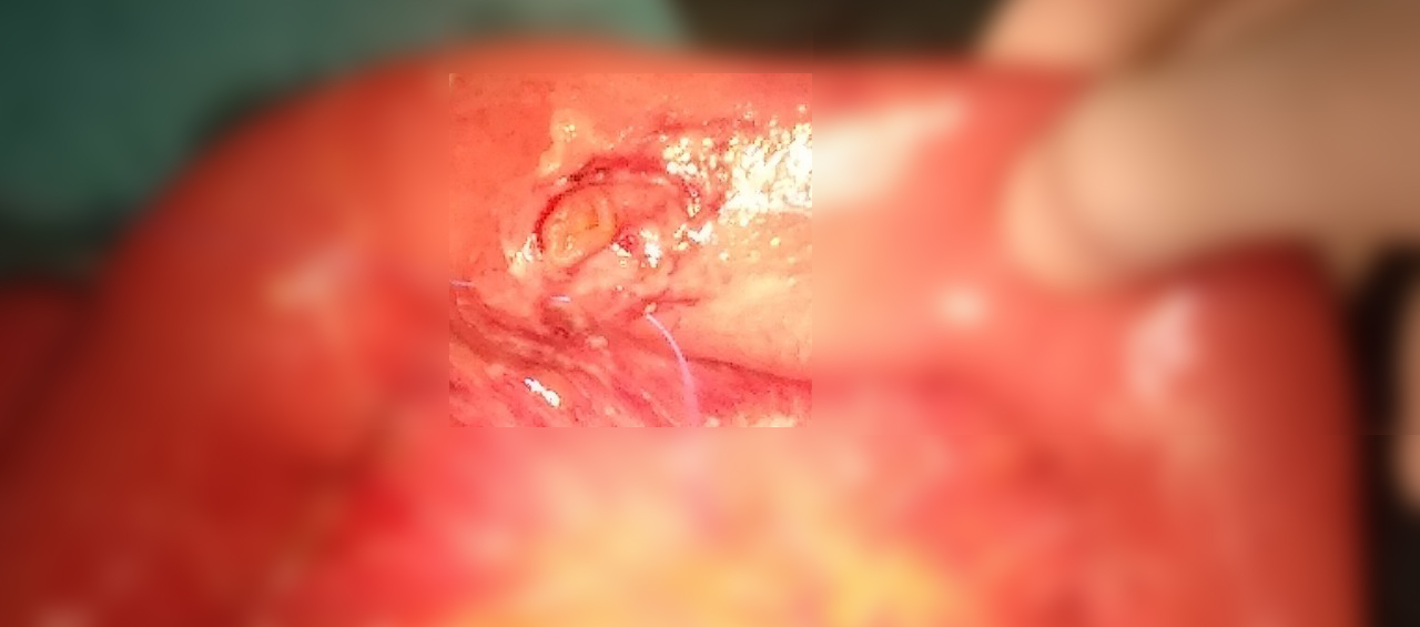 Cấp cứu thủng ruột