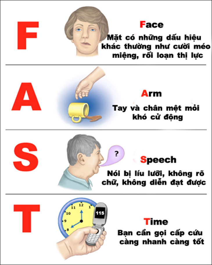 Đột quỵ